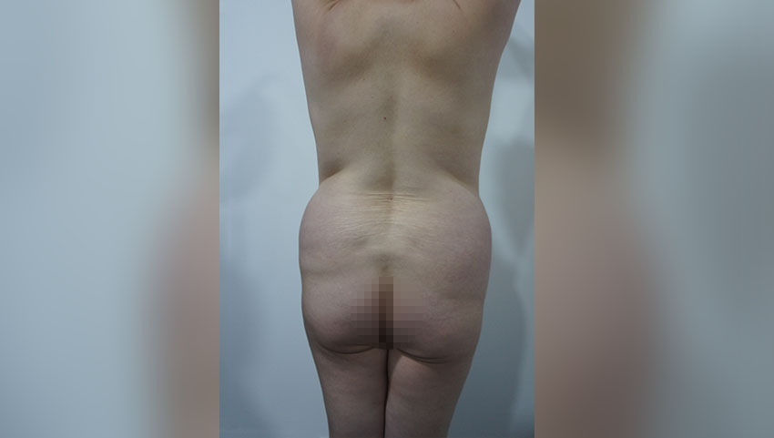 Abdominoplastia Circular con Liposucción (Antes)